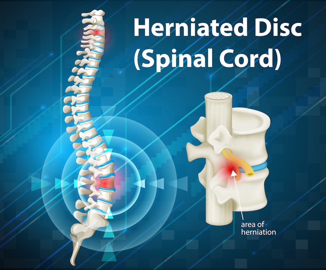 Maximize Compensation for Motorcycle Accident Spinal Cord Injury