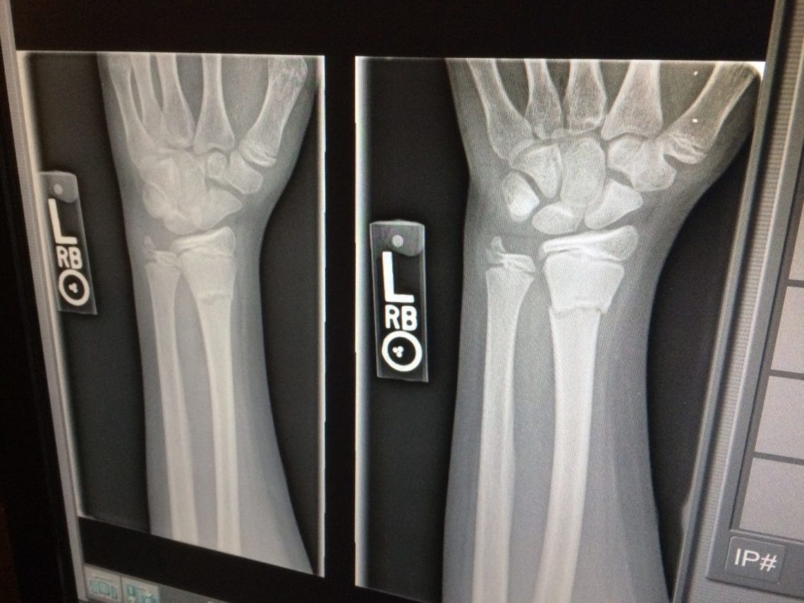How Insurance Companies Value Accident Injury Claims